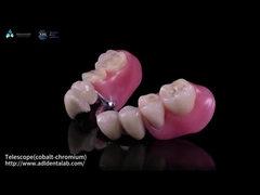 दूरबीन आंतरिक Co-Cr और बाहरी Co-Cr धातु आंशिक रूप से मिश्रित के साथ