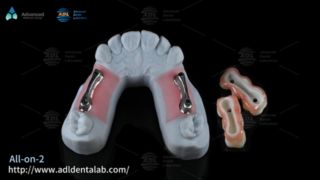 सभी ऑन एक्स डेंटिस्ट्री के लिए प्रीमियम टाइटेनियम इंप्लांट बार