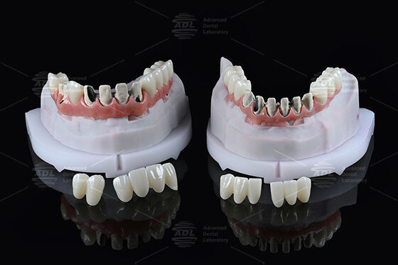 खरीदें चीन डेंटल लैब टाइटेनियम फुल आर्क हाइब्रिड ब्रिज तत्काल लोडिंग के साथ ए 1 शेड मालोन्ग डिजाइन पेंच कैड/कैम बनाए रखा ऑनलाइन निर्माण